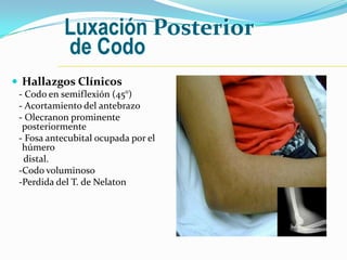 Luxación Posterior
            de Codo
 Hallazgos Clínicos
 - Codo en semiflexión (45°)
 - Acortamiento del antebrazo
 - Olecranon prominente
  posteriormente
 - Fosa antecubital ocupada por el
  húmero
  distal.
 -Codo voluminoso
 -Perdida del T. de Nelaton
 