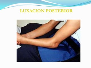 LUXACION POSTERIOR
 