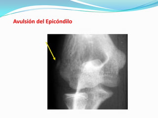 Avulsión del Epicóndilo
 