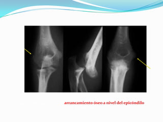 Luxación posterior con arrancamiento óseo a nivel del epicóndilo y la
                            epitróclea
 