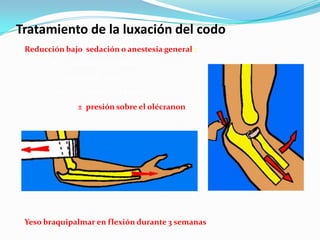Tratamiento de la luxación del codo
 Reducción bajo sedación o anestesia general :
        Tracción del antebrazo
        en flexión de codo
       contra tracción del brazo
              ± presión sobre el olécranon




 Yeso braquipalmar en flexión durante 3 semanas
 