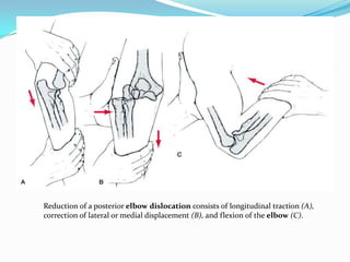 Reduction of a posterior elbow dislocation consists of longitudinal traction (A),
correction of lateral or medial displacement (B), and flexion of the elbow (C).
 