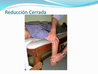 Reducción Cerrada
 