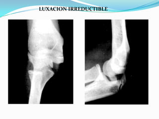 LUXACION IRREDUCTIBLE
 