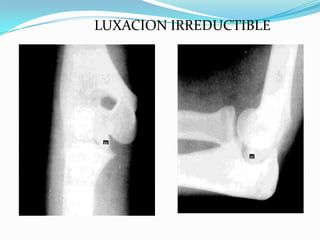 LUXACION IRREDUCTIBLE
 