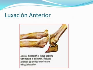Luxación Anterior
 