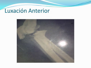 Luxación Anterior
 