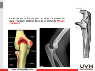 • La asociación de fractura de coronoides, de cabeza de
radio y luxación posterior del codo se denomida TRIADA
TERRIBLE.
 