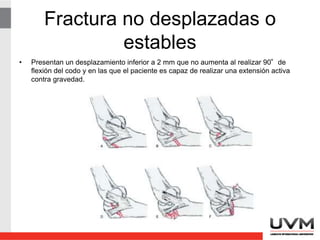 Fractura no desplazadas o
estables
• Presentan un desplazamiento inferior a 2 mm que no aumenta al realizar 90°de
flexión del codo y en las que el paciente es capaz de realizar una extensión activa
contra gravedad.
 