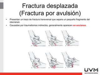 Fractura desplazada
(Fractura por avulsión)
• Presentan un trazo de fractura transversal que separa un pequeño fragmento del
olecranon.
• Causadas por traumatismos indirectos, generalmente aparecen en ancianos.
 