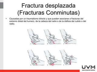 Fractura desplazada
(Fracturas Conminutas)
• Causadas por un traumatismo directo y que pueden asociarse a fracturas del
extremo distal del humero, de la cabeza del radio o de la diáfisis del cubito o del
radio.
 