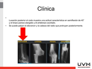 Clínica
•
Luxación posterior el codo muestra una actitud característica en semiflexión de 45°
y el brazo parece alargado y él antebrazo acortado.
• Se puede palpar el olécranon y la cabeza del radio que protruyen posteriormente.
 