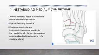 1 INESTABILDIAD MEDIAL Y CUNEIFORME
1. tornillo insertado desde el cuneiforme
medial al cuneiforme medio
2.Fijación flexible y dinámica
3.Fusión de la articulación
intercuneiforme con un tornillo de
tracción (el tornillo de tracción no debe
entrar en la articulación entre la cuña
medial y lateral)
 