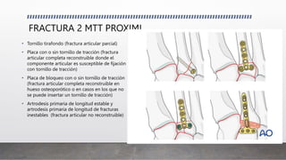 FRACTURA 2 MTT PROXIML
• Tornillo tirafondo (fractura articular parcial)
• Placa con o sin tornillo de tracción (fractura
articular completa reconstruible donde el
componente articular es susceptible de fijación
con tornillo de tracción)
• Placa de bloqueo con o sin tornillo de tracción
(fractura articular completa reconstruible en
hueso osteoporótico o en casos en los que no
se puede insertar un tornillo de tracción)
• Artrodesis primaria de longitud estable y
artrodesis primaria de longitud de fracturas
inestables (fractura articular no reconstruible)
 