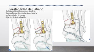 Inestabilidad de Lisfranc
Coloque el tornillo insertado desde la
base del segundo metatarsiano hasta la
cuña medial o viceversa.
Fijación dinámica flexible
 