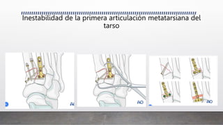 Inestabilidad de la primera articulación metatarsiana del
tarso
 