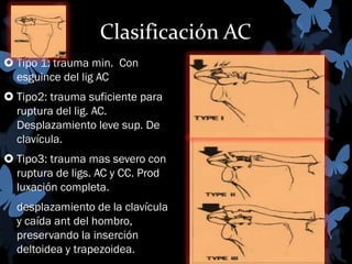 Clasificación AC
 Tipo 1: trauma min. Con
esguince del lig AC
 Tipo2: trauma suficiente para
ruptura del lig. AC.
Desplazamiento leve sup. De
clavícula.
 Tipo3: trauma mas severo con
ruptura de ligs. AC y CC. Prod
luxación completa.
desplazamiento de la clavícula
y caída ant del hombro,
preservando la inserción
deltoidea y trapezoidea.

 