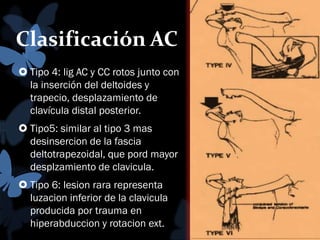 Clasificación AC
 Tipo 4: lig AC y CC rotos junto con
la inserción del deltoides y
trapecio, desplazamiento de
clavícula distal posterior.
 Tipo5: similar al tipo 3 mas
desinsercion de la fascia
deltotrapezoidal, que pord mayor
desplzamiento de clavicula.

 Tipo 6: lesion rara representa
luzacion inferior de la clavicula
producida por trauma en
hiperabduccion y rotacion ext.

 
