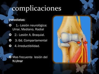 complicaciones
Inmediatas:


1.- Lesión neurológica:
Ulnar, Mediano, Radial

 2.- Lesión A. Braquial.
 3.-Sd. Compartamental
 4.-Irreductibilidad.
 Mas frecuente lesión del
N.Ulnar

 