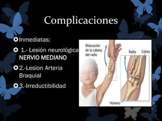 Complicaciones
Inmediatas:
 1.- Lesión neurológica:
NERVIO MEDIANO
2.-Lesion Arteria
Braquial
3.-Irreductibilidad

 