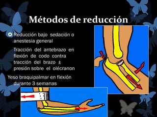 Métodos de reducción
 Reducción bajo sedación o
anestesia general
Tracción del antebrazo en
flexión de codo contra
tracción del brazo ±
presión sobre el olécranon
Yeso braquipalmar en flexión
durante 3 semanas

 