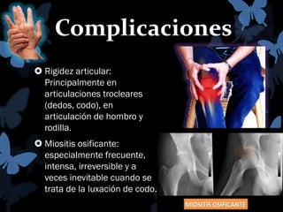 Complicaciones
 Rigidez articular:
Principalmente en
articulaciones trocleares
(dedos, codo), en
articulación de hombro y
rodilla.
 Miositis osificante:
especialmente frecuente,
intensa, irreversible y a
veces inevitable cuando se
trata de la luxación de codo.

 