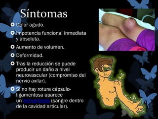 Síntomas
 Dolor agudo.
 Impotencia funcional inmediata
y absoluta.

 Aumento de volumen.
 Deformidad.
 Tras la reducción se puede
producir un daño a nivel
neurovascular (compromiso del
nervio axilar).
 Si no hay rotura cápsuloligamentosa aparece
un hemartrosis (sangre dentro
de la cavidad articular).

 
