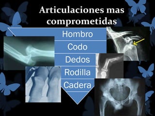 Articulaciones mas
comprometidas
Hombro
Codo
Dedos
Rodilla
Cadera

 