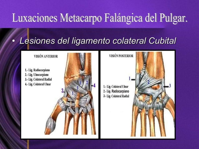 luxaciones-metacarpofalangicas-y-falangicas-grandes-traumatismos-de-la