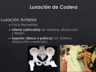 44
Luxación de Cadera
Luxación Anterior
 