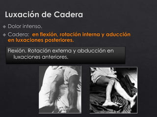 Luxación de Cadera
Flexión. Rotación externa y abducción en
luxaciones anteriores.
 