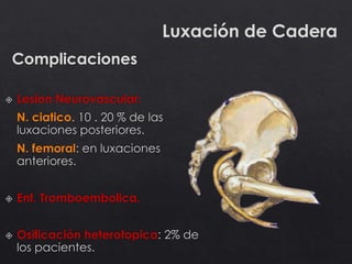 Luxación de Cadera
Complicaciones
 