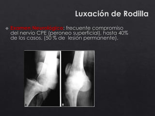 Luxación de Rodilla
 