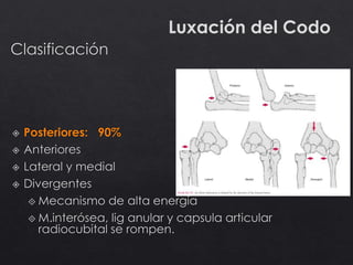 Luxación del Codo
 