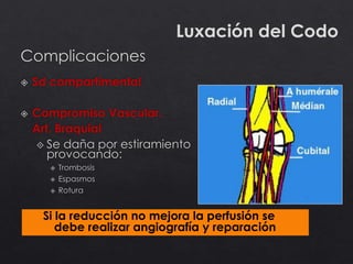 Luxación del Codo
Si la reducción no mejora la perfusión se
debe realizar angiografía y reparación
 