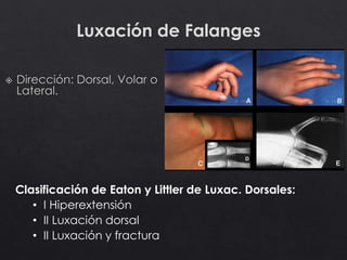 Luxación de Falanges
Clasificación de Eaton y Littler de Luxac. Dorsales:
• I Hiperextensión
• II Luxación dorsal
• II Luxación y fractura
 