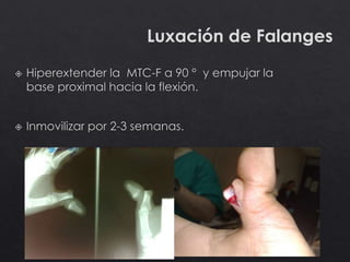 Luxación de Falanges
 