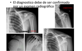 • El diagnostico debe de ser confirmado
por un examen radiográfico
normal
subglenoidea
 