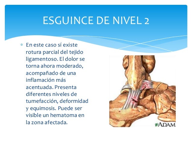 Consulta En Casos De Esguinces En Bogota Colombia Esguince Ortopedia Y Traumatologia Fracturas