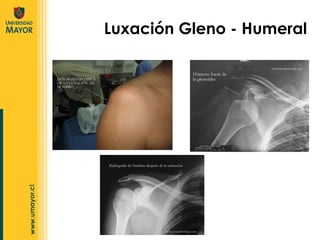 Luxación Gleno - Humeral 