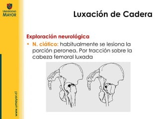 Luxación de Cadera Exploración neurológica N. ciático:  habitualmente se lesiona la porción peronea. Por tracción sobre la cabeza femoral luxada 