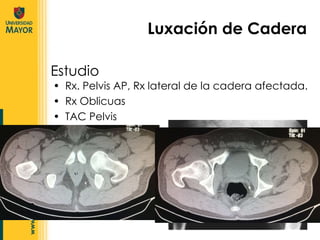 Rx. Pelvis AP, Rx lateral de la cadera afectada. Rx Oblicuas TAC Pelvis Luxación de Cadera Estudio 