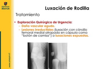Exploración Quirúrgica de Urgencia: Daño vascular agudo. Lesiones irreductibles  (luxación con cóndilo femoral medial atrapado en cápsula como “botón de camisa”) o  luxaciones expuestas. Luxación de Rodilla Tratamiento 