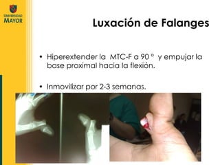 Hiperextender la  MTC-F a 90 °  y empujar la base proximal hacia la flexión. Inmovilizar por 2-3 semanas. Luxación de Falanges 