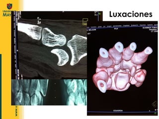 Luxaciones 