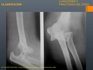 LUXACIONES Y
FRACTURAS DEL CODOCLASIFICACIÓN
A.D. DELGADO MARTINEZ. Cirugía Ortopédica y Traumatología. Madrid: Panamericana, 2009.
 