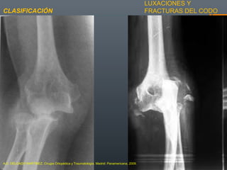 LUXACIONES Y
FRACTURAS DEL CODOCLASIFICACIÓN
A.D. DELGADO MARTINEZ. Cirugía Ortopédica y Traumatología. Madrid: Panamericana, 2009.
 