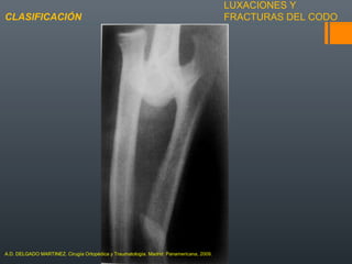 LUXACIONES Y
FRACTURAS DEL CODOCLASIFICACIÓN
A.D. DELGADO MARTINEZ. Cirugía Ortopédica y Traumatología. Madrid: Panamericana, 2009.
 
