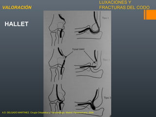 LUXACIONES Y
FRACTURAS DEL CODOVALORACIÓN
HALLET
A.D. DELGADO MARTINEZ. Cirugía Ortopédica y Traumatología. Madrid: Panamericana, 2009.
 
