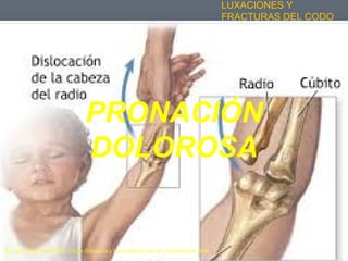 LUXACIONES Y
FRACTURAS DEL CODO
PRONACIÓN
DOLOROSA
A.D. DELGADO MARTINEZ. Cirugía Ortopédica y Traumatología. Madrid: Panamericana, 2009.
 